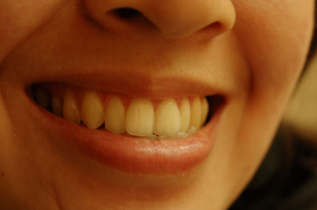 teeth 1435698 639x423
